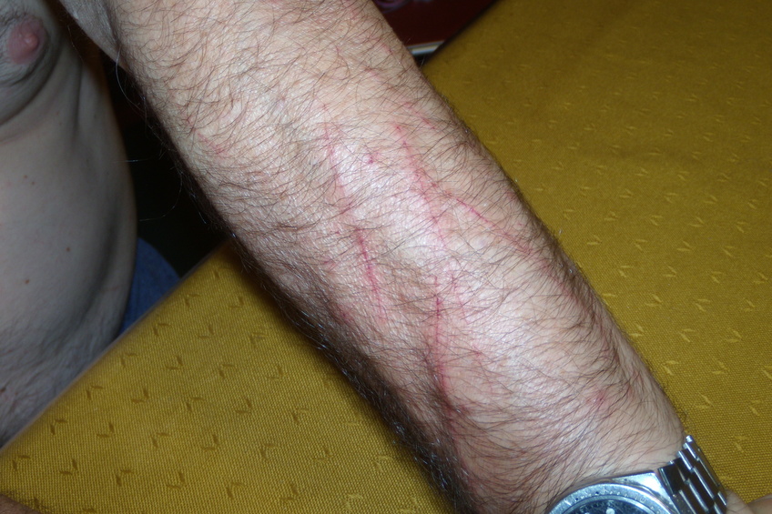 Heridas de guerra en el monte para alcanzar la confluencia - War injuries in the bushes to reach the confluence